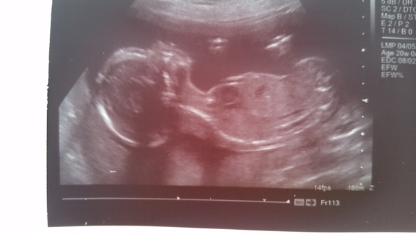 February 2016 - Boobs are growing, sickness is going, and some of us are finally showing!!