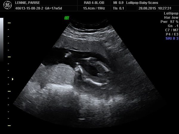 Expecting PFB- is he definitely a boy?