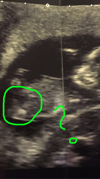 Nub theory - boy or girl