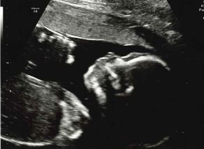 February 2016 - Boobs are growing, sickness is going, and some of us are finally showing!!