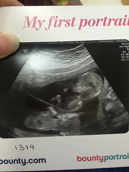 Twin and multiple AN thread