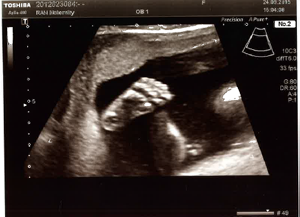 February 2016 - Boobs are growing, sickness is going, and some of us are finally showing!!