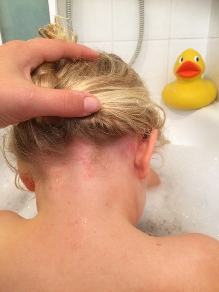 Is it chicken pox?