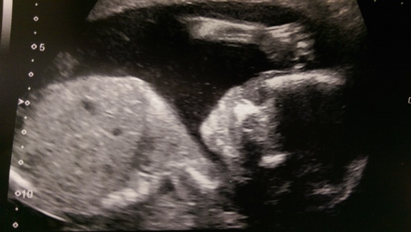 February 2016 - Boobs are growing, sickness is going, and some of us are finally showing!!