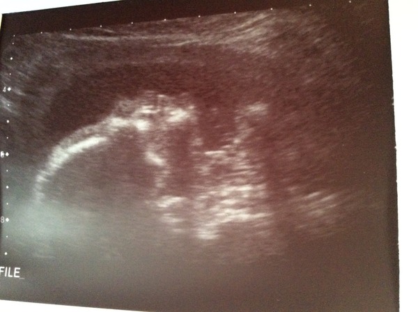 February 2016 - Boobs are growing, sickness is going, and some of us are finally showing!!