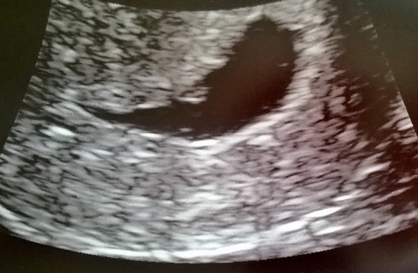 Recurrent Miscarriage Support Thread 30 - Support for Tests, Treatments and Trying Again