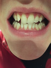 Has anyone used Mr Blanc whitening strips?
