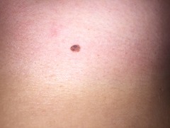 Would you be worried about this mole?