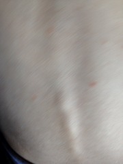 Please help ID this rash!