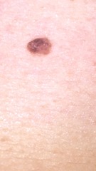 Would you be worried about this mole?