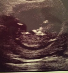 Can anyone see a nub in this scan photo?