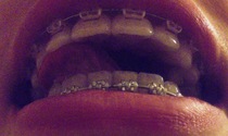 Adult braces - still not happy :(