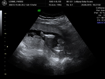 Expecting PFB- is he definitely a boy?