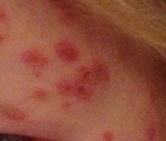 Your experience of chicken pox