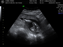 Expecting PFB- is he definitely a boy?