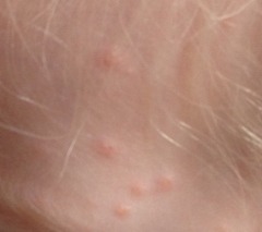 Your experience of chicken pox