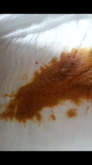 taadaa shiny new gastrostomy support thread no.3 tube feeding support