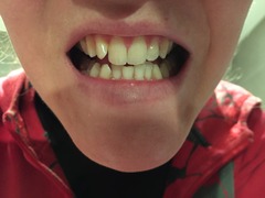 Has anyone used Mr Blanc whitening strips?