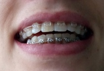 Adult braces - still not happy :(
