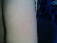 Please help ID this rash!