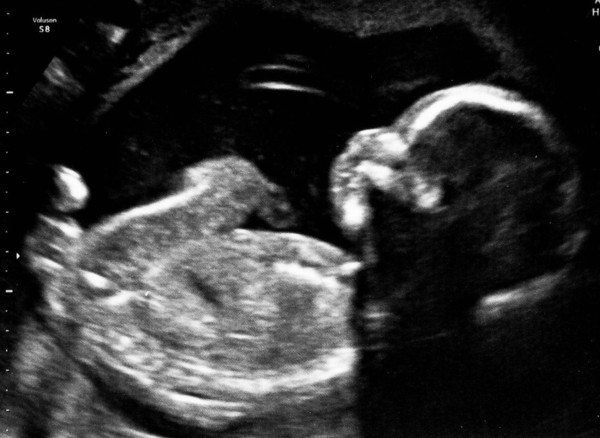 February 2016 - Boobs are growing, sickness is going, and some of us are finally showing!!