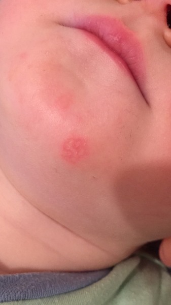 Is this the start of impetigo? Pic attached