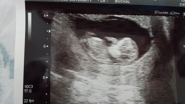 April 2016 babies. Nausea, bloating and wind - feeling HOT!