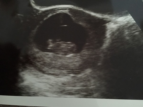 June 2016 Babies - Thread 2 - The first trimester, first scans and seeing little heartbeats