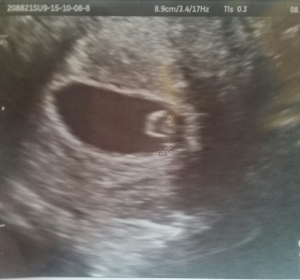 Would you be my Infertility/Clomid/Follicle tracking friend please?!