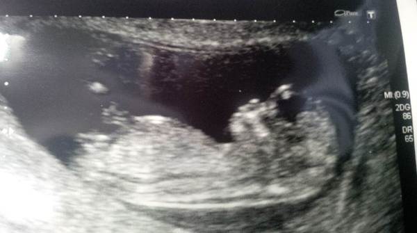 Does the nub show on this scan picture??