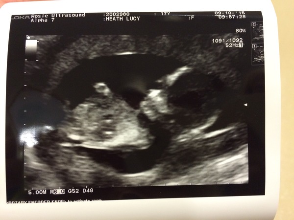 13+1 week scan - nub theorists help???