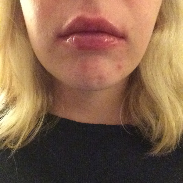 Lip enhancement.