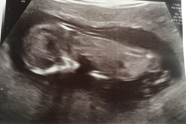 April 2016 babies. Nausea, bloating and wind - feeling HOT!