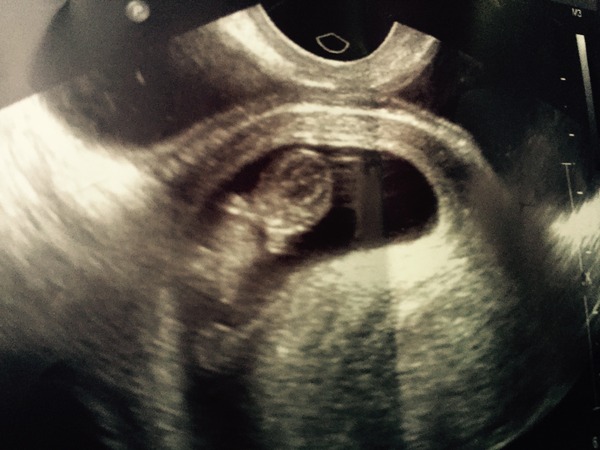 June 2016 Babies - Thread 2 - The first trimester, first scans and seeing little heartbeats