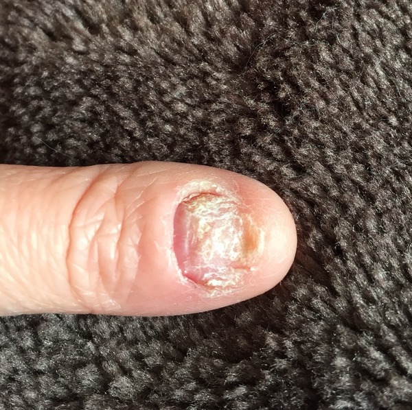 hideous nail! *grim photo*