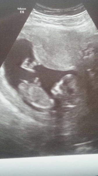 Boy or girl? Any ideas :)