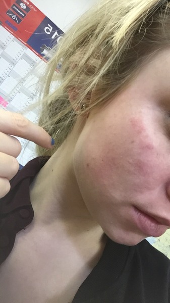 Please recommend a good moisturizer cream for dry, red patchy skin?