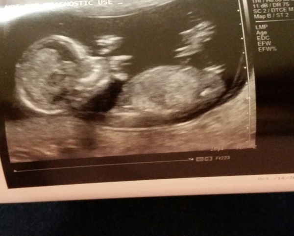 April 2016 babies. Nausea, bloating and wind - feeling HOT!