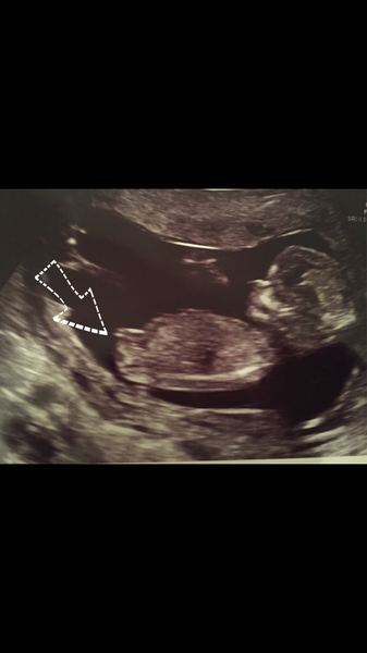Gender scan on Monday - any pre appt guesses??? I think boy!