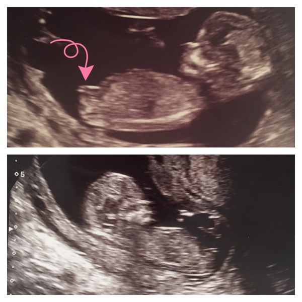 Boy or Girl Nub? I have no clue what I'm looking for!! Is it guff??