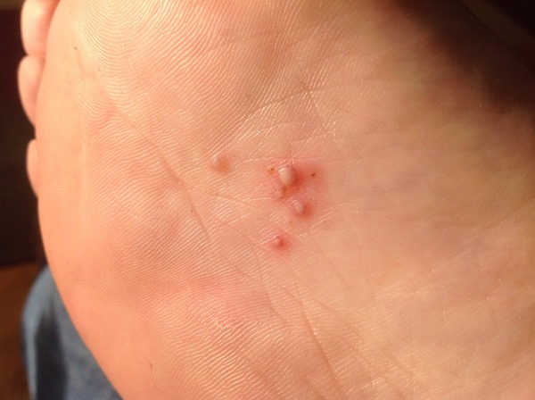 What's this on my foot?  It's driving me crazy!