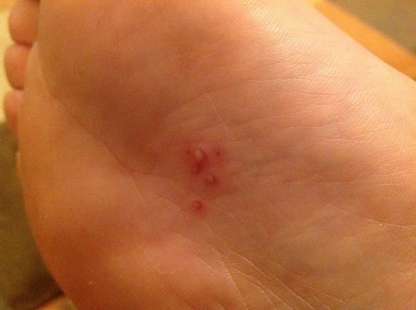 What's this on my foot?  It's driving me crazy!