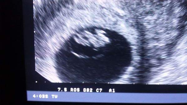 June 2016 #3, 12 week scans - Will you PLEASE hurry up?