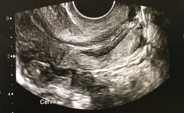 Diffuse thickening of cervical canal