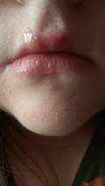 to ask for help coping with cold sores...