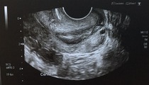 Diffuse thickening of cervical canal