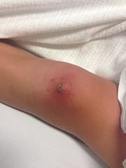 Australians should stop milking spiders