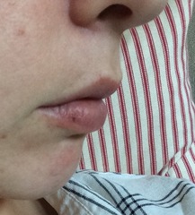 Lip enhancement.