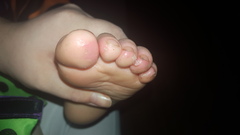 Doctor doesn't know. Toes peeling.
