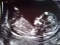 April 2016 babies. Nausea, bloating and wind - feeling HOT!